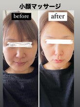 鍼灸整骨院ナガサキ(nagasaki)/小顔マッサージ