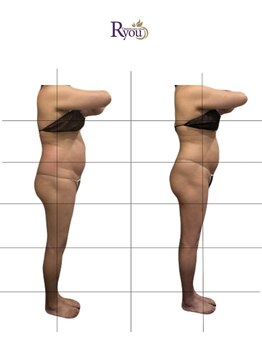 アールユー ギンザ(Ryou ginza)/セルゼロ ビフォーアフター