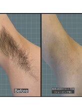 アレッド 大阪店(ared.)/脇脱毛