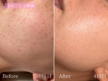 テン(10ten)/ニキビ・赤み軽減