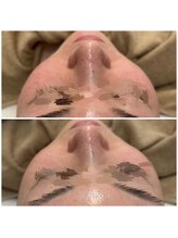 リグレム バイ フェローズ(Riglem by fellows)/毛穴洗浄ハイドロトリートメント