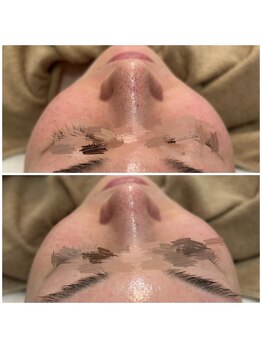 リグレム バイ フェローズ(Riglem by fellows)/毛穴洗浄ハイドロトリートメント