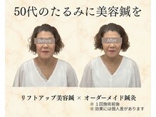 望鍼灸院の雰囲気(ビフォーアフター【シワ/ほうれい線/たるみ/肩こり/美容鍼】)