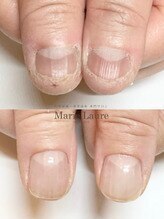 マリーロール 梅田店(Marie Laure)/自爪育成/深爪矯正/ネイルケア