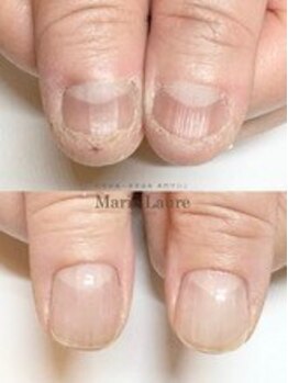 マリーロール 梅田店(Marie Laure)/自爪育成/深爪矯正/ネイルケア