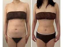 美人バスト 新宿店/☆姉妹店ダイエット症例写真☆