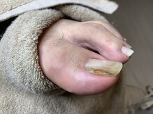足楽 京都御池店/お爪に穴が開いて…