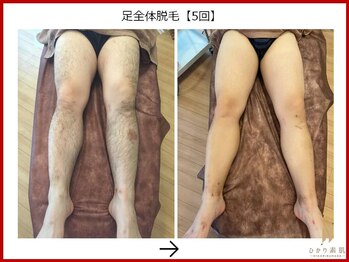 ひかり素肌/足脱毛5回