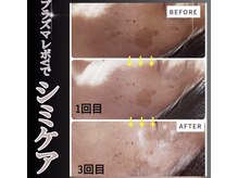 オリーブ(Olive)の雰囲気（気になるシミの改善も◎低温プラズマで肌を痛めずケア）