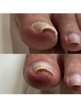 リリ(lili)/巻き爪矯正3回目（左親指）