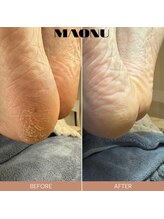 マオヌー(MAONU)/式足裏角質ケア　症例写真