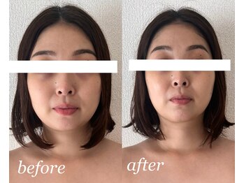 アトリエドゥアージュ(Atelier de age)/1回で小顔にコウシリフト40分1