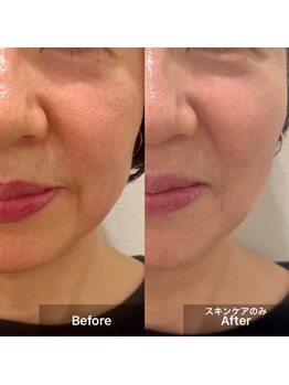 チアアップ 練馬(Cheer up)/艶玉ピーリング