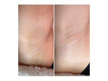 ソワンドボーテ クー(Soin de Beaut'e Quu)/◇脱毛/わきビフォーアフター