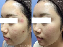 エピア 西尾店(Epia)/頬ニキビ/20代女性