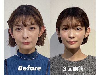 コルミチョン サロン(骨美整 salon)/Before・After(左右非対称施術)