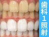 【会員/回数券】20分×1回歯科提携セルフホワイトニング