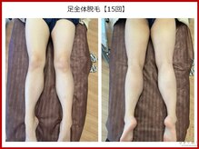 ひかり素肌/足脱毛15回