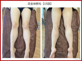 ひかり素肌/足脱毛15回