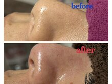 リジュベ 古河店(Rejuve)/毛穴エクストラクション