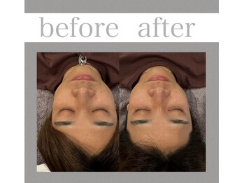 キクキク(KIKUKIKU)/小顔頭蓋骨矯正×美容鍼