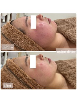 サロンディト(ditto)/【施術1回】小顔コルギ+カスマラ