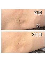 レイモード(Ray mode)/ワキ脱毛