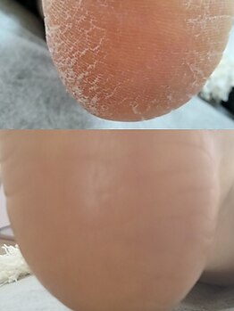 リゼランアンドコー 福島鎌田店(LIZERA&Co)の写真/【ガサガサかかとにお悩みの方に◎】初回施術で効果実感！本格的な角質ケアと丁寧な施術でツルツル足裏に♪