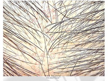 アン ビューティー(ann beauty)/施術4回【症例写真】40代