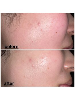 ミニョン(mignon)/肌質変えませんか？