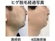 アッシュボウプラス(H.beau+)の写真/高出力照射で効果は確実◎奈良県内でメンズに特化した脱毛機は当店だけ◎