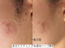 サロンヴェアリー 広尾(salon vary)/部分ハーブ12,000円～