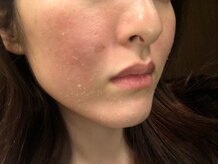 ビークレアーズ ビビ(B-crears. ViVi)/剥離するタイプで実感が◎