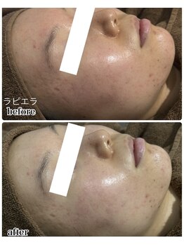 エンチャント(ENCHANT)/ラピエラピーリングでツル卵肌