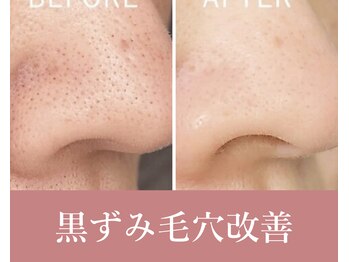 ビップフィール(vip feell)/黒ずみ毛穴/角栓除去★毛穴洗浄