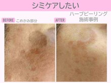 ぷるるんエステ/ハーブピーリング/ピーリング