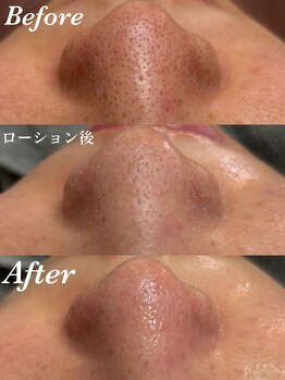 コリー(Kolly)/定期的な毛穴洗浄