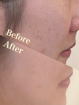 ビューティーアート イツモ(Beauty art ITSUMO)の写真/毛穴/アクネ跡/ザラつきが気になる人必見!リピート率100%のオリジナルクレンジングでツルスベ肌をゲット！