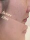 ビューティーアート イツモ(Beauty art ITSUMO)の写真/毛穴/アクネ跡/ザラつきが気になる人必見!リピート率100%のオリジナルクレンジングでツルスベ肌をゲット！