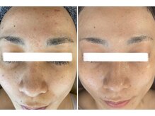 美時雨の雰囲気(毛穴皮脂詰まりや黒ずみにお悩みの方肌の根本から改善しませんか)