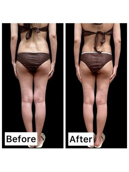 クールヴィラ(Cool Villa)/太ももビフォーアフター