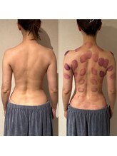 ビレイ(Birei)/カッサ＋カッピング