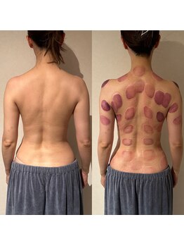 ビレイ(Birei)/カッサ＋カッピング