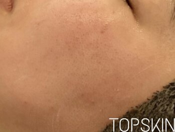トップスキン 名駅(TOPSKIN)/月イチハーブで肌管理♪