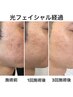 口コミ必須【女性8月限定クーポン】光フォトUPフェイシャル＋Wうなじ¥13,000