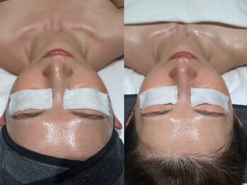 フロムミー 銀座本店(FROM ME)/3Xダーマジオ