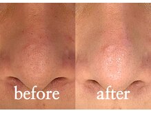 ボヌール(bonheur)/【毛穴改善】ハイドラ毛穴洗浄