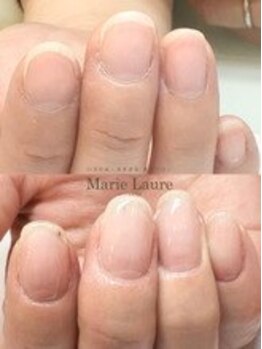マリーロール 梅田店(Marie Laure)/自爪育成/深爪矯正/ネイルケア