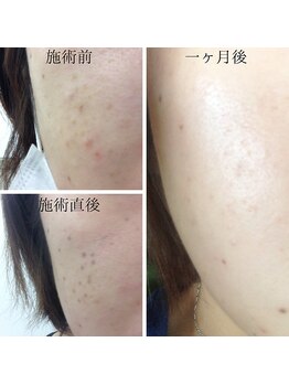 アブニールブリヨン/シミケア経過写真[シミケア]