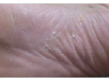 リゼラアンドコー 宇都宮店/フットケア、白癬